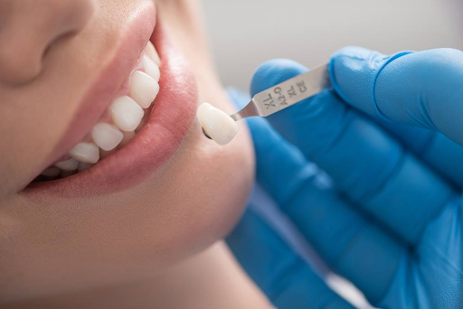 Invest in Your Smile: The Value of Porcelain Veneers Cost